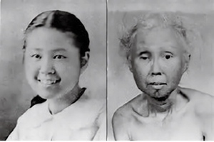 ウェルナー症候群の女性（15歳、左）、同じ女性の48歳のときの写真（右）