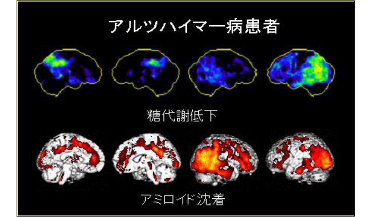 アルツハイマー病患者｜糖代謝低下｜アミロイド沈着