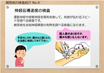 （ちらし）糖尿病の検査紹介No.4　神経伝導速度の検査　運動神経や感覚神経を電気刺激して、刺激が伝わるスピードを調べる検査です。糖尿病性末梢神経障害の有無を調べる検査になります。手足のしびれ、痛みなど感じたら主治医に相談してみて下さい。個人差がありますが、痛みを感じる人もいます。