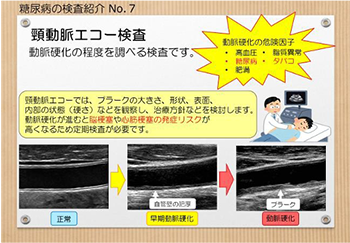 （ちらし）糖尿病の検査紹介No.7　頸動脈エコー検査　動脈硬化の程度を調べる検査です。　動脈硬化の危険因子：高血圧、糖尿病、肥満、脂質異常、たばこ　頸動脈エコーでは、プラークの大きさ、形状、表面、内部の状態（硬さ）などを観察し、治療方針などを県道治します。動脈硬化が進むと脳梗塞や心筋梗塞の発症リスクが高くなるため定期検査が必要です。