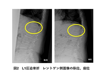 図2L1圧迫骨折レントゲン側面像の臥位、座位