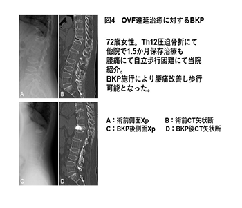 図4OVF遅延治癒に対するBKP 72歳女性。Th12圧迫骨折にて他院で1.5か月保存治療も腰痛にて自立歩行困難にて当院紹介。BKP施行により腰痛改善し歩行可能となった。