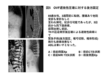 図5OVF遅発性圧壊に対する後方固定 85歳女性。3週間前に転倒、腰痛あり他院受診も骨折なしと言われ帰宅。杖歩行可能であったが、3日前から両下肢麻痺。尿開出現し受診。Th11圧迫骨折後圧壊による遅発性麻痺にて緊急手術(後方固定、椎弓切除、椎体形成)施行も麻痺改善無くADLは車いすとなった。