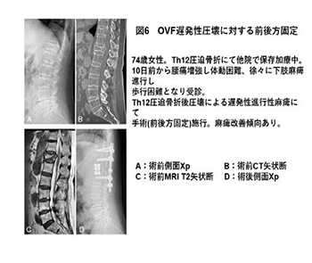 図6OVF遅発性圧壊に対する前後方固定 74歳女性。Th12圧迫骨折にて他院で保存加療中。10日前から腰痛増強し体動困難、徐々に下肢麻痺進行し歩行困難となり受診。Th12圧迫骨折後圧壊による遅発性進行性麻痺にて手術(前後方固定)施行。麻痺改善傾向あり。