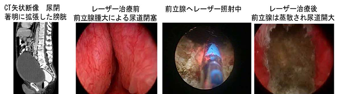 CT矢状断像　尿閉　著明に拡張した膀胱→レーザー治療前　前立腺腫大による尿道閉塞→前立腺へレーザー照射中→レーザ治療後　前立腺は蒸散され尿道開大