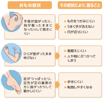 痙縮による症状と困ることについておもに3つの症状がある。おもな症状:手首が曲がったり、指が握ったままになったりして開きにくい。その症状により、困ること:ものをつかみにくい。うまく手が洗えない。爪が切りにくい。おもな症状:肘が曲がったまま伸びない。その症状により、困ること:着替えにくい。人や物にぶつかってしまう。おもな症状:足がつっぱったり、足先が足の裏側の方に曲がったりして動かしにくい。その症状により、困ること:歩きにくい。転倒しやすくなる。