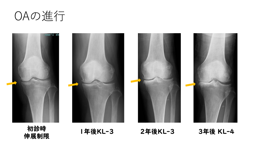 OAの進行→初診時伸展制限→1年後KL-3→2年後KL-3→3年後KL-4