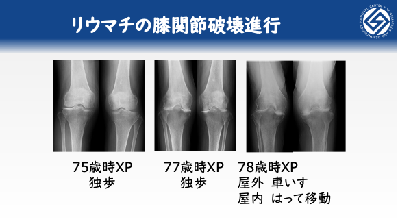 リウマチの膝関節破壊進行：75歳時XP独歩→77歳時XP独歩→78歳時XP屋外車いす屋内はって移動
