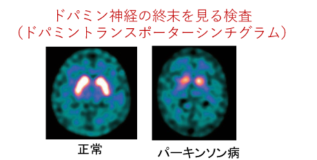ドパミン神経の終末を見る検査（ドパミントランスポーターシンチグラム）左の画像は正常、右の画像はパーキンソン病