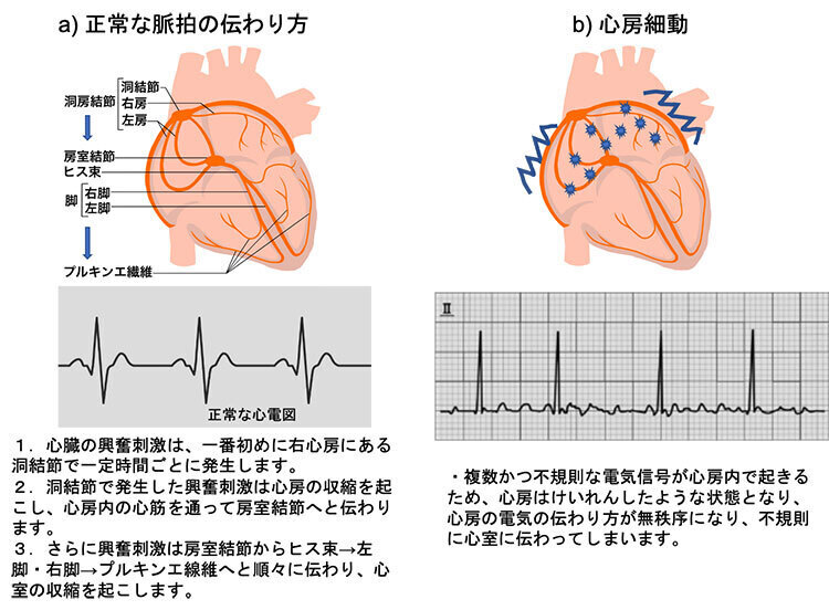 「a．正常な脈拍の伝わり方」１．心臓の興奮刺激は、一番初めに右心房にある洞結節で一定時間ごとに発生します。２．洞結節で発生した興奮刺激は心房の収縮を起こし、心房内の心筋を通って房室結節へと伝わります。３．さらに興奮刺激は房室結節からヒス束→左脚・右脚→プルキンエ線維へと順々に伝わり、心室の収縮を起こします。「b．心房細動」複数かつ不規則な電気信号が心房内で起きるため、心房はけいれんしたような状態となり、心房の電気の伝わり方が無秩序になり、不規則に心室に伝わってしまいます。