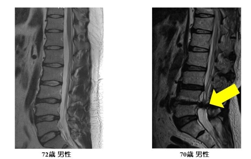 左図、72歳男性の正常腰椎の撮像。右図、70歳男性の腰部脊柱管狭窄症の撮像。