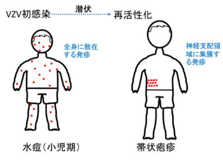 VZV初感染:全身に散在する発疹(水痘(幼少期))。再活性化:神経支配領域に集蔟する発疹(帯状疱疹)。VZV初感染から潜伏期間を経て再活性化を図示。