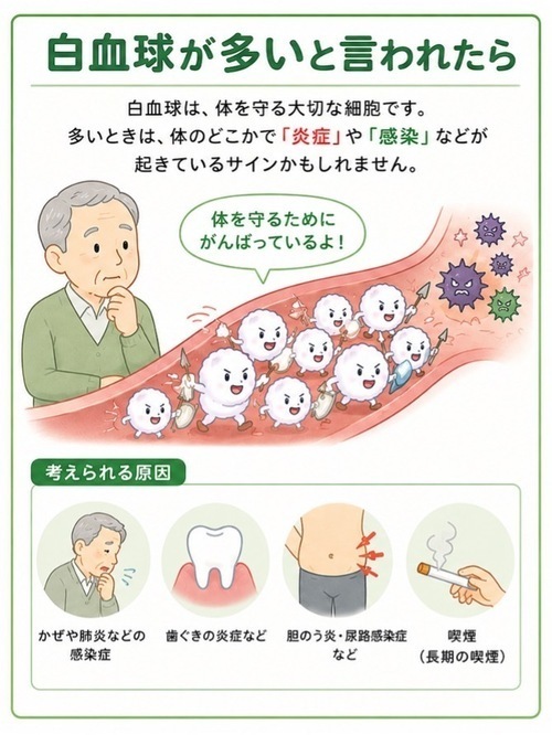 【白血球が多いと言われたら】白血球は、体を護る大切な細胞です。多いときは、体のどこかで「炎症」や「感染」などが起きているサインかもしれません。体を守るためにがんばっているよ!【考えられる原因】かぜや肺炎などの感染症、歯ぐきの炎症など、胆のう炎、尿路感染症など、喫煙(長期の喫煙)
