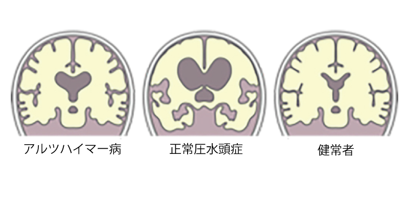 水頭症のひと 歩行障害・認知症・尿失禁があるときは  〜正常圧水頭症