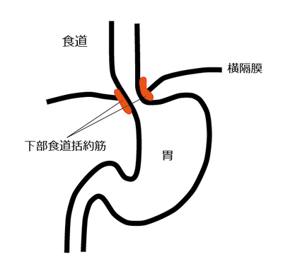 逆流性食道炎の図