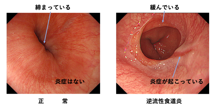 逆流性食道炎の比較画像：食道がしまっている場合炎症はなく正常、食道がゆるんでいる場合えんしょうが炎症が起こっていて逆流性食道炎。