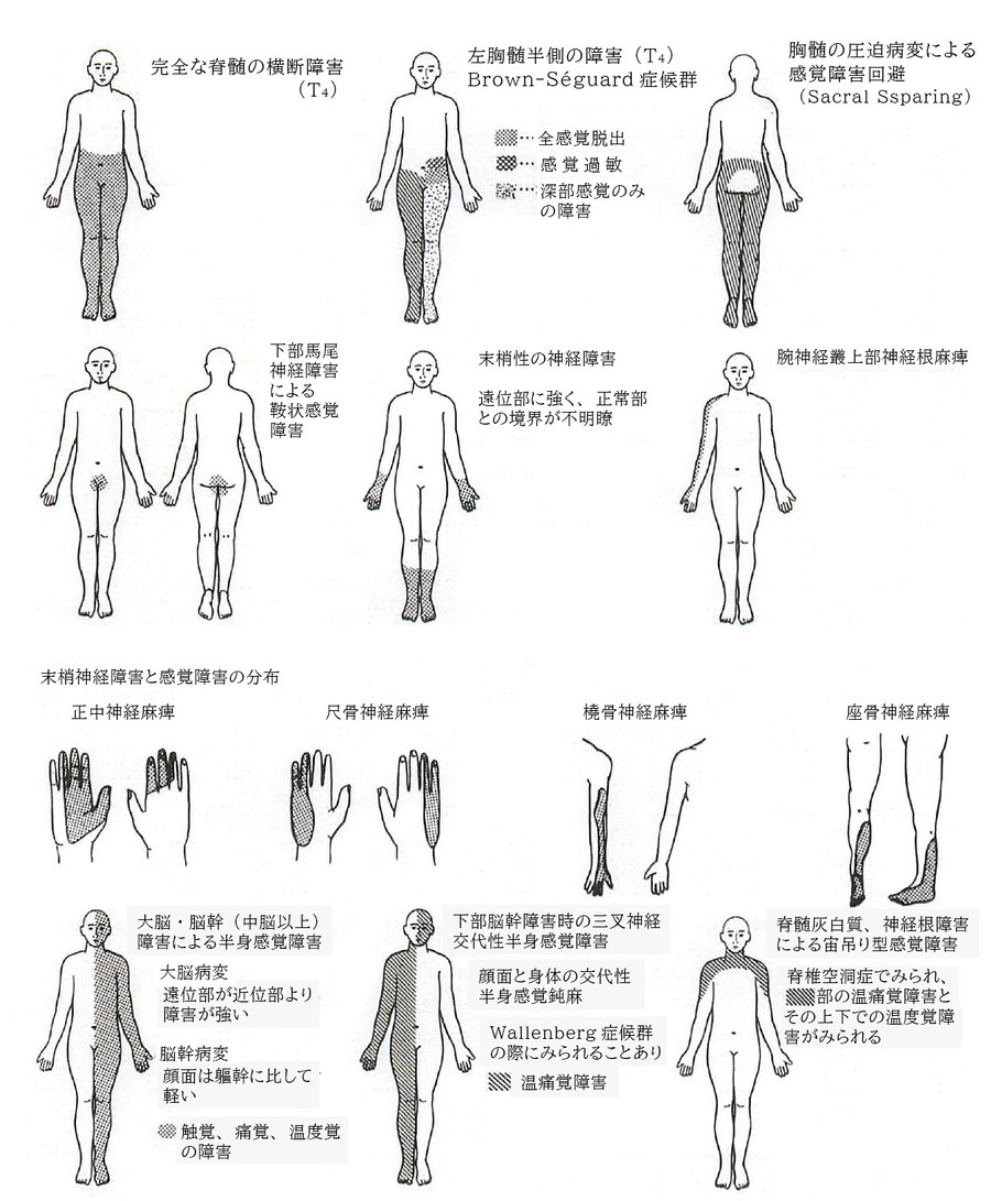 下肢 の 痺れ 鑑別