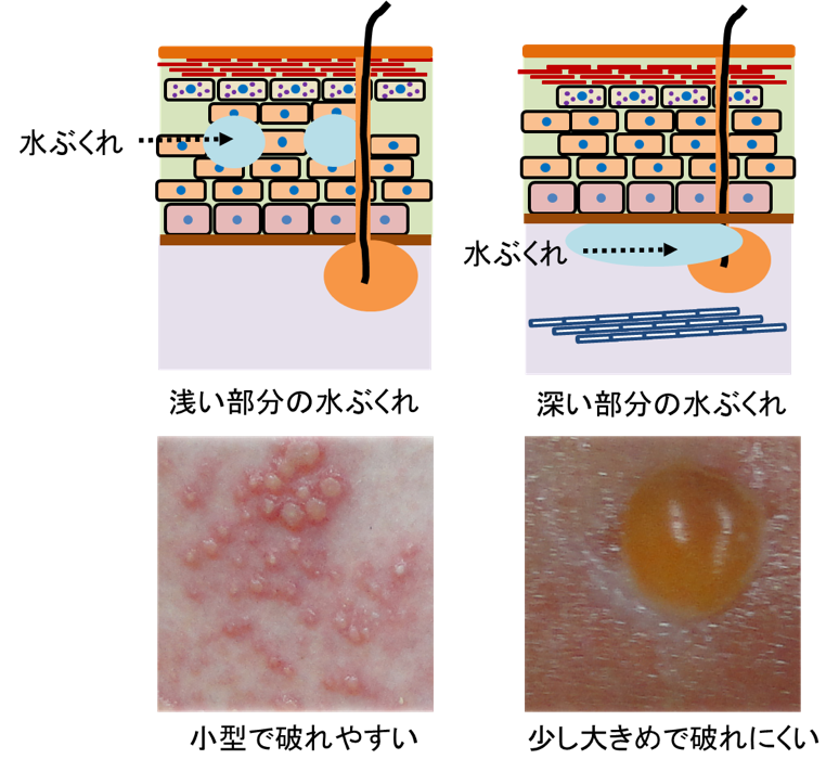 水ぶくれの原因は 国立長寿医療研究センター