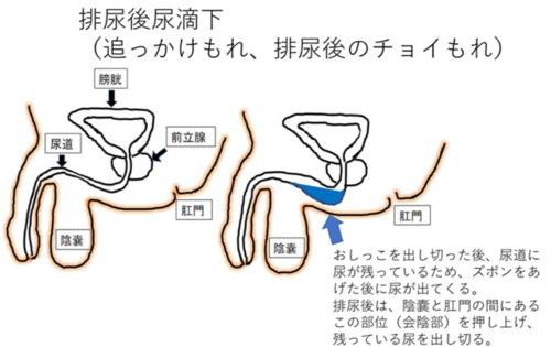 排尿後尿滴下