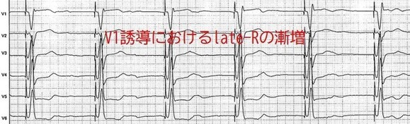 V1誘導における波形の変化