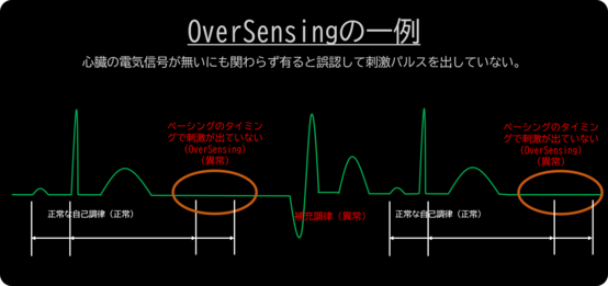 OverSensingの一例