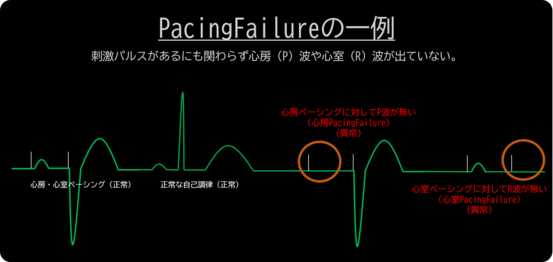 PacingFailureの一例