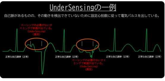 UnderSensingの一例