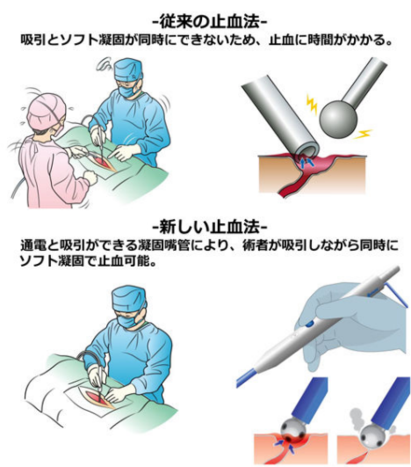 サクションボールコアギュレーターを使用した新たな手技