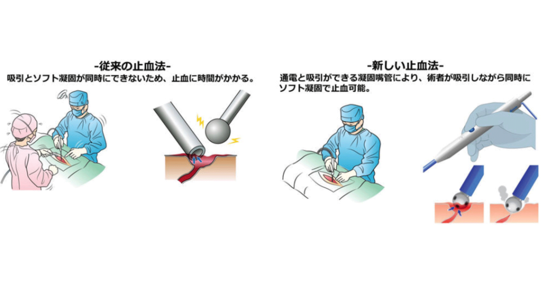 電気メスは手術に有効ですか? – 電気メス メス先 使い分け – OGEGK