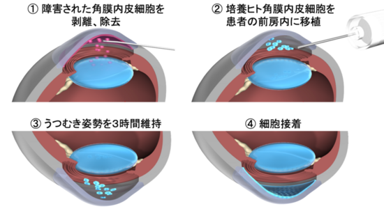 ビズノバ手術手順1.障害された角膜内皮細胞を剥離、除去2.培養ヒト角膜内皮細胞を患者の前房内に移植3.うつむき姿勢を3時間維持4.細胞接着