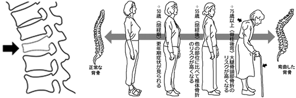 高齢者のための転倒防止セルフチェック