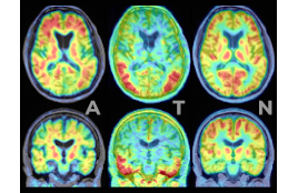 Neuroimaging