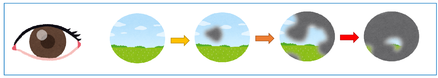 正常な見え方から3段階で緑内障が進み視界が狭くなっていく様子を示した画像。