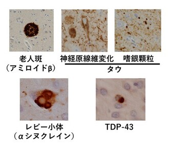 ferroptosis