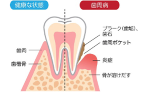 歯周病は歯肉、歯槽菌を破壊していく