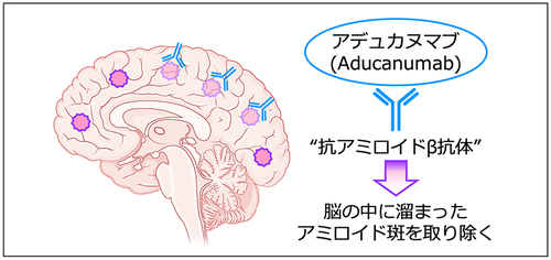 アデュカヌマブは，アルツハイマー病の原因と考えられるアミロイド斑を脳から取り除くことを目的として開発された薬です。