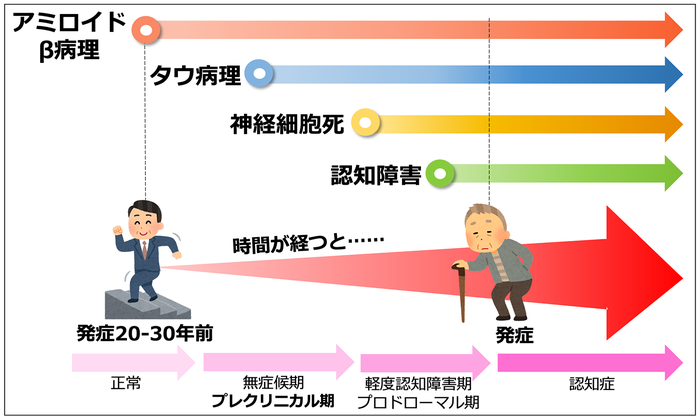 アルツハイマー病は、症状が出る20〜30年以上前から、脳の中でアミロイドβがたまり始め、アミロイド斑が数十年に渡り脳にダメージを与え続けた結果、脳の炎症反応や、タウ病理が脳の中に広がるなど、発症した時点では既に神経細胞が失われつつあります。