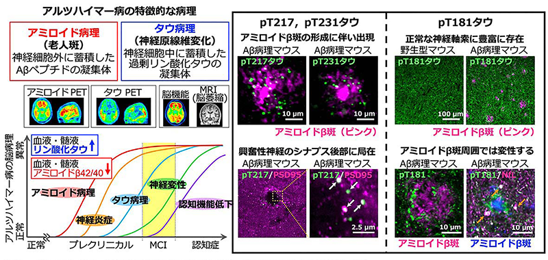 アルツハイマー病の病態進行の概要